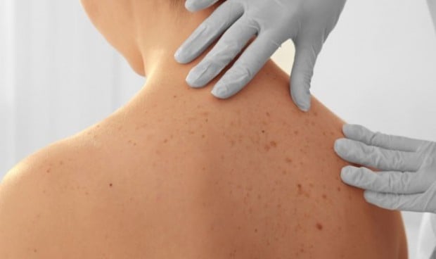 Virus, radiación UV e inmunosupresión, factores de riesgo en cáncer de piel