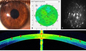 Vissum Miranza realiza un implante de células madre en distrofia corneal