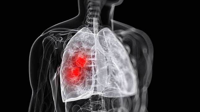 ¿Cómo se diagnostica el absceso de pulmón?