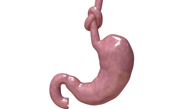 ¿Cuál es el pronóstico de la achalasia?