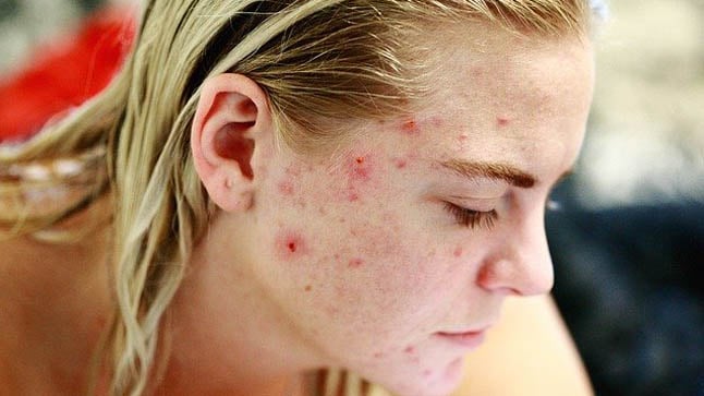 ¿Cómo se diagnostica el acné?