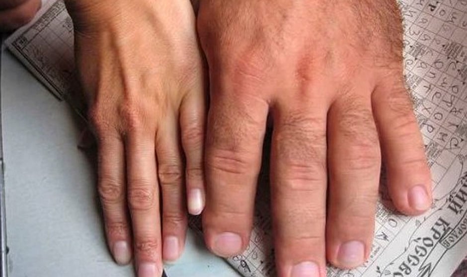La acromegalia o gigantismo provoca el agrandamiento de manos y pies