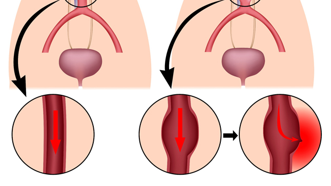 Causas, síntomas y tratamiento de una aneurisma aórtico