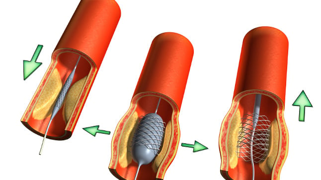 ¿Qué es una angioplastia coronaria y stents?