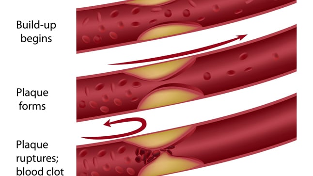 Causas, síntomas y tratamiento de la arteriosclerosis