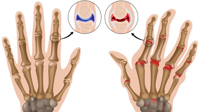 Causas, síntomas y tratamiento de la artritis reumatoide