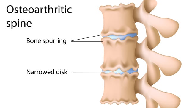 Causas, síntomas y tratamiento de la artrosis