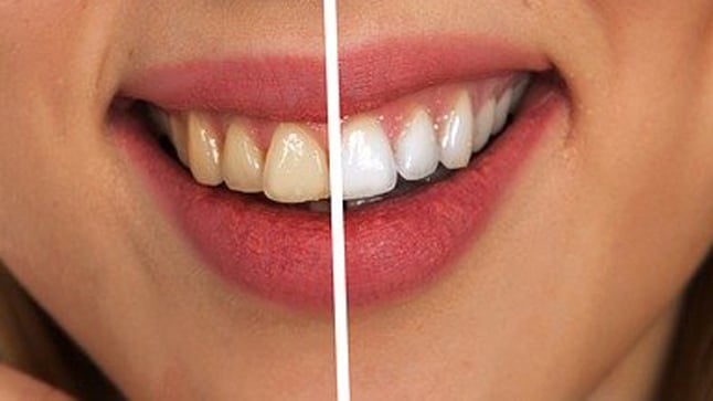 ¿Para quién está indicado un tratamiento de blanqueamieno dental?