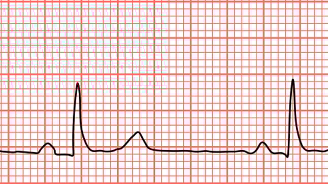  ¿Cómo se diagnostica la bradicardia?