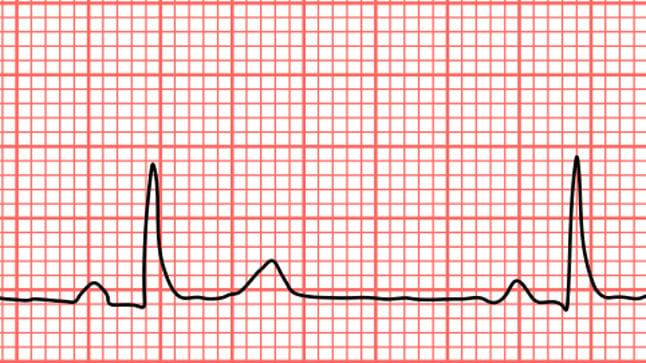  ¿Cómo se diagnostica la bradicardia?