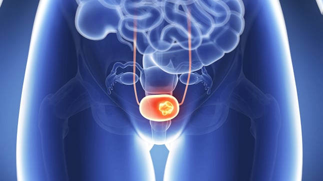 Causas, síntomas y tratamiento del cáncer de cérvix