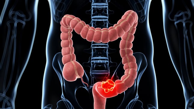 Causas, síntomas y tratamiento del cáncer de colon