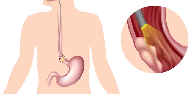 malignant pleural effusion icd