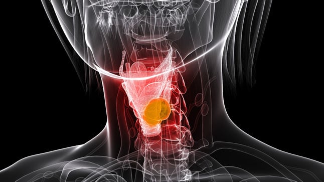 ¿Qué es el cáncer de laringe y cómo se previene?
