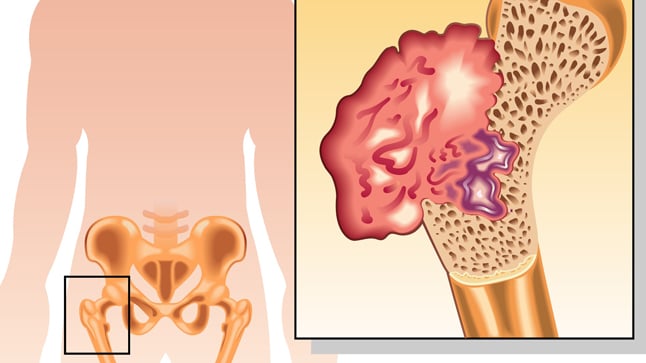 Tipos, causas y tratamiento del cáncer óseo