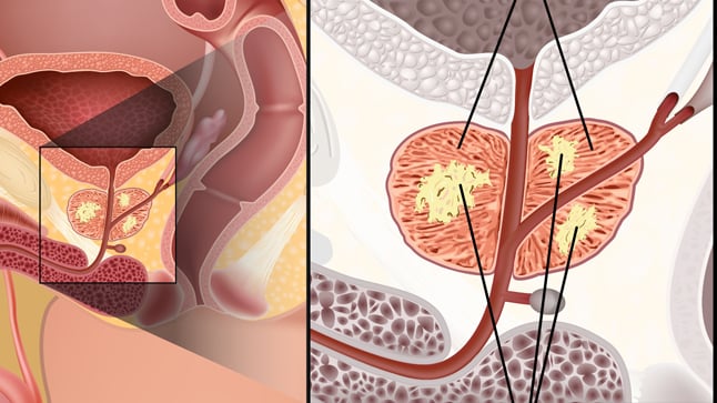 Causas, síntomas y tratamiento del cáncer de próstata