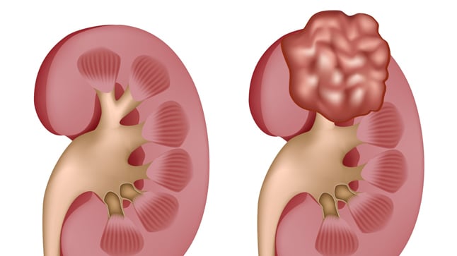 Causas, síntomas y tratamiento del cáncer de riñón