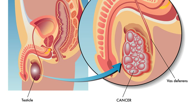 Causas, síntomas y tratamiento del cáncer de testículos