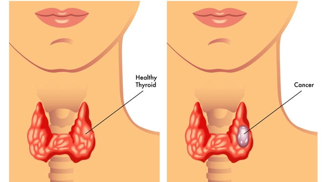 Causas, síntomas y tratamiento del cáncer de tiroides