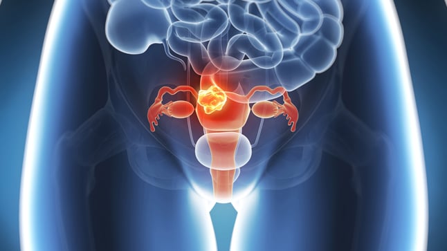 Causas, síntomas y tratamiento del cáncer de útero