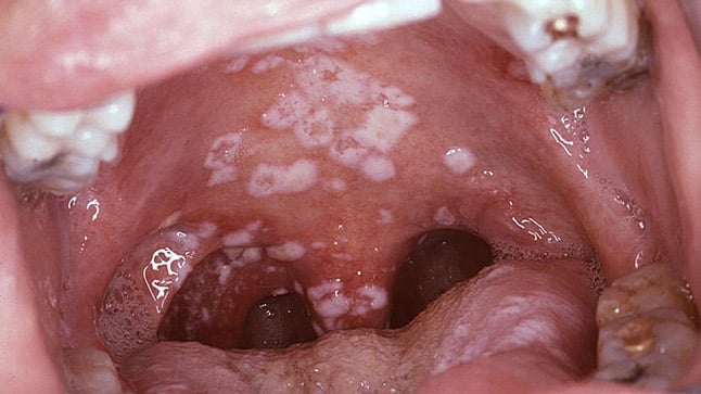 ¿Cómo se diagnostica de la candidiasis oral?