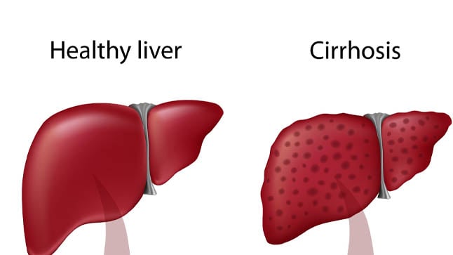 ¿Cómo se diagnostica la cirrosis hepática?