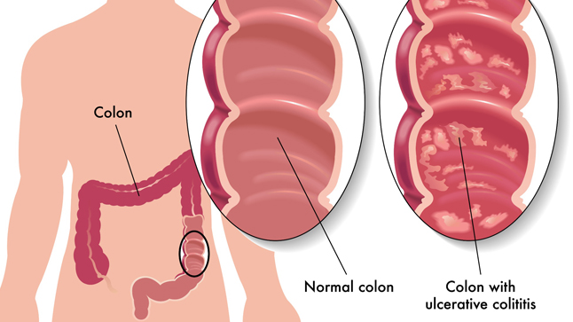  ¿Cuál es el pronóstico de la colitis ulcerosa?