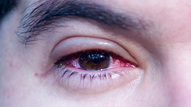 lagrimas artificiales hidratacion ocular conjuntivitis