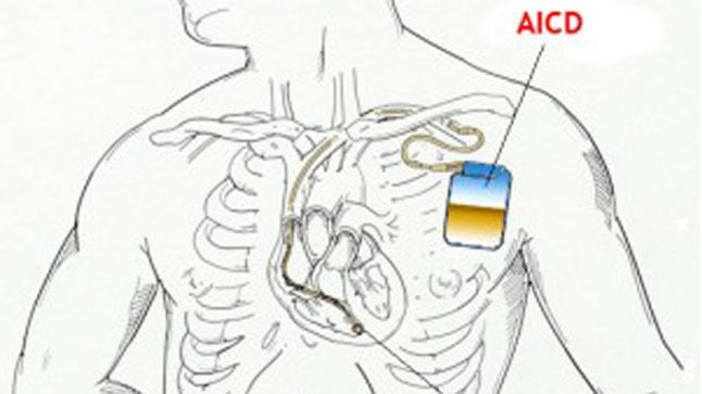 Cuidados en el día a día para pacientes con desfibrilador implantable