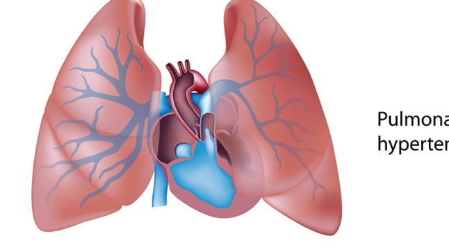 Causas, síntomas y tratamientos del Cor Pulmonale