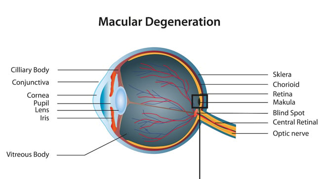 Clasificación de la degeneración macular