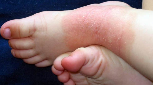 ¿Cómo se diagnostica la dermatitis atópica?