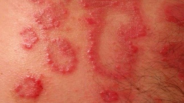 Dermatitis de causas, síntomas y tratamiento