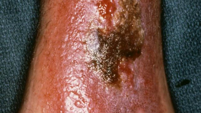 ¿Cómo se diagnostica la dermatitis de estasis?