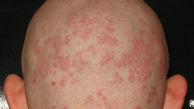 Dermatitis seborreica del cuero cabelludo - BySimone