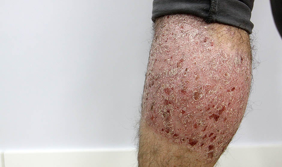 Dermatitis: tipos, causa y tratamiento
