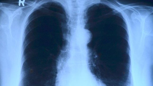 ¿Cómo se diagnostica el derrame pleural?