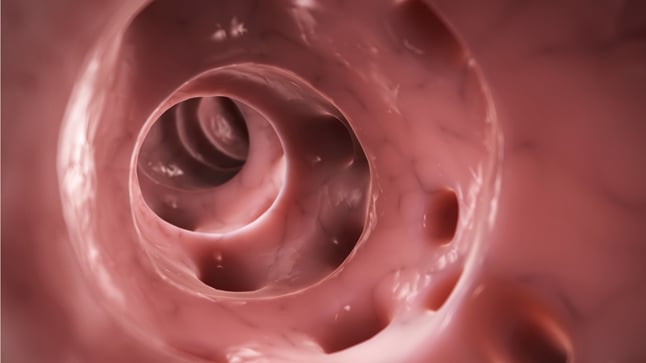 ¿Cuál es el pronóstico de la diverticulosis?