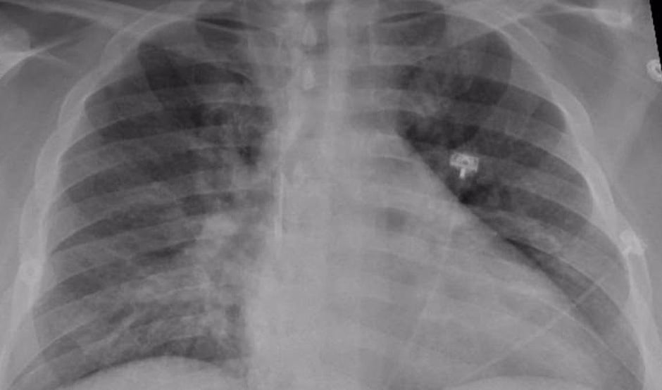 Radiografía de pulmones afectados por edema pulmonar