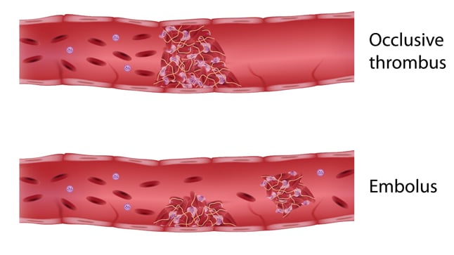 Embolia: causas, síntomas y tratamiento