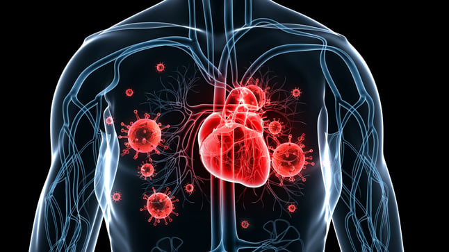 Causas, síntomas y tratamiento de la endocarditis