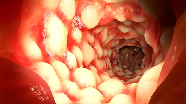 ¿Cuál es el pronóstico de la enfermedad de Crohn?