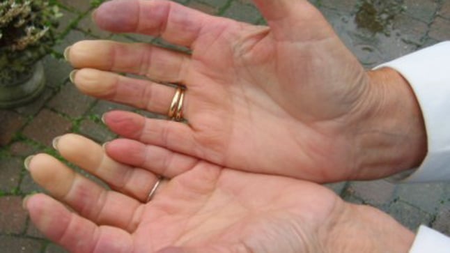 ¿Cuáles son las causas de la enfermedad de Raynaud?