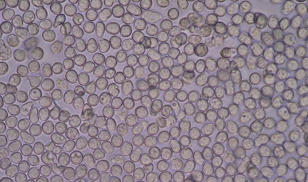 ¿Cómo se diagnostica la eosinofilia?