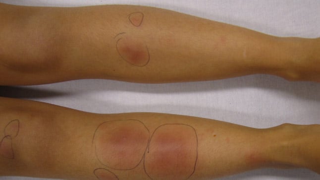 ¿Cómo se diagnostica el eritema nodoso?