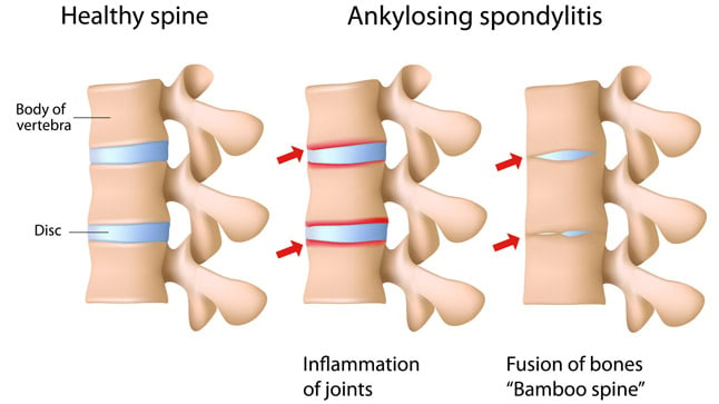 Cauas, sítnomas, complicaciones y tratamiento de la espondilitis anquilosante