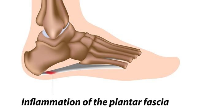 Fascitis plantar. ¿Qué es y cómo tratarla?