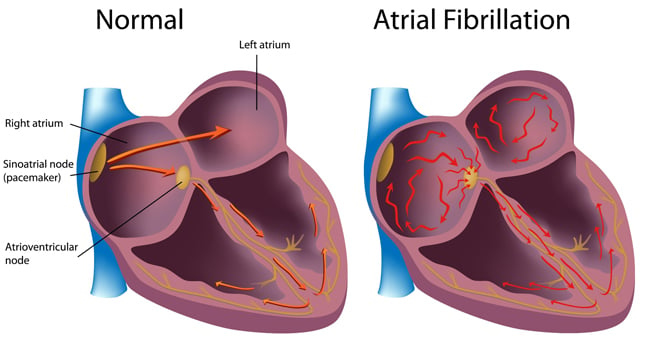 Causas, síntomas y tratamiento de la fibrilación auricular