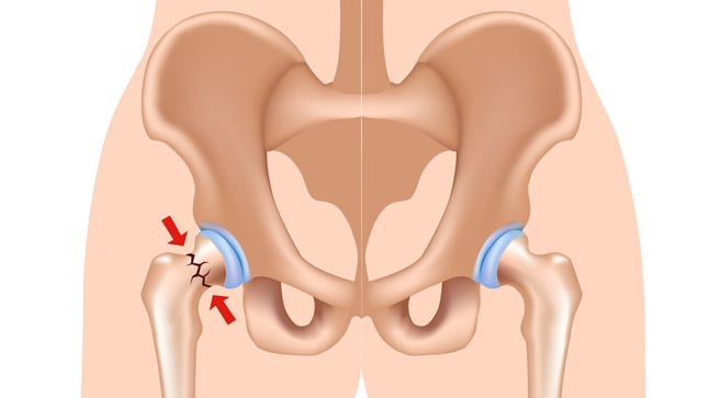 ¿Cuáles son las complicaciones de la fractura de cadera?