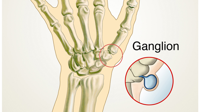 ¿Cómo se diagnostican los gangliones?